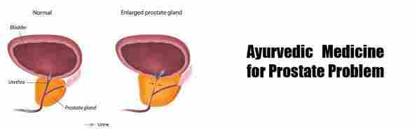 Ayurvedic Medicine for Prostate Problem