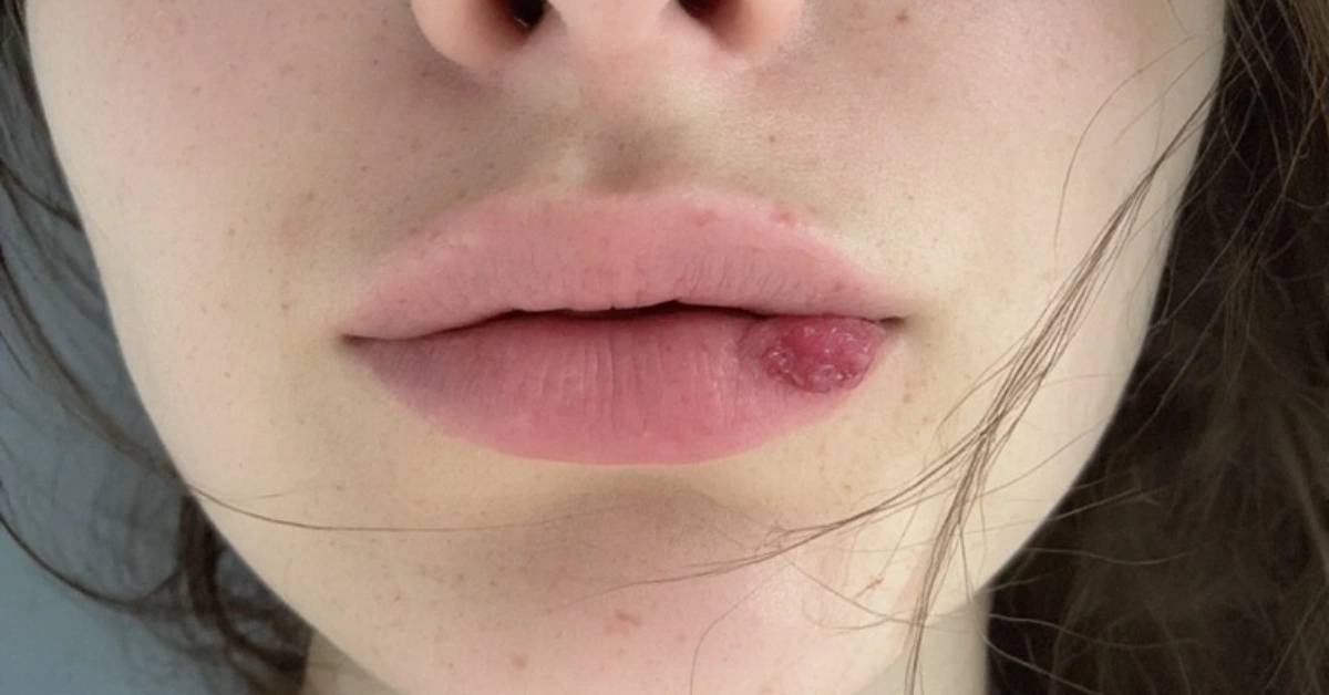 मुखको घाउ (Mouth Ulcers)