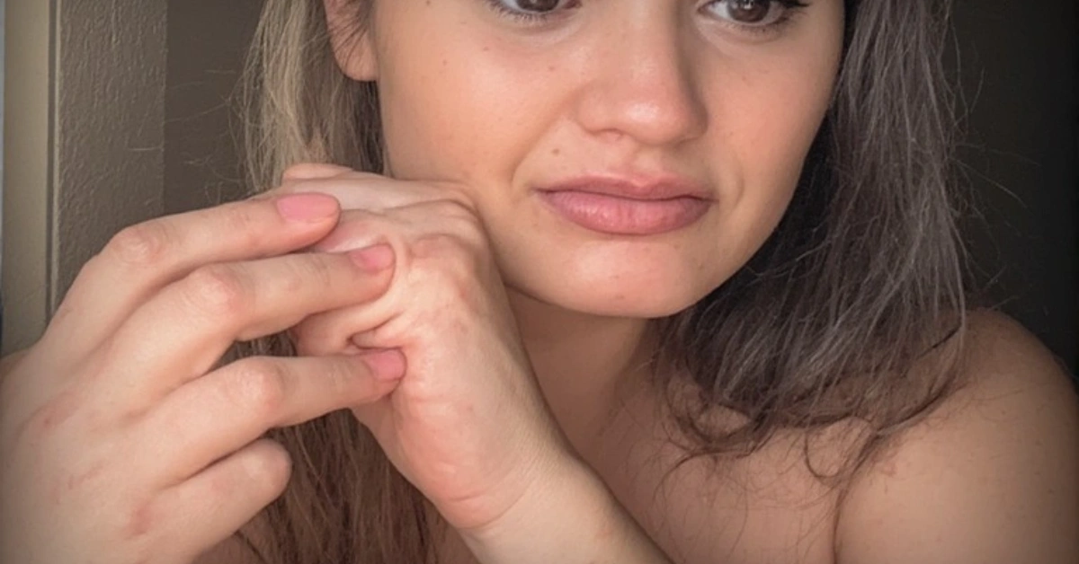 एक्जिमा (चिलाउने रोग) को घरेलु उपचार (Home Remedies for Eczema or Itching)