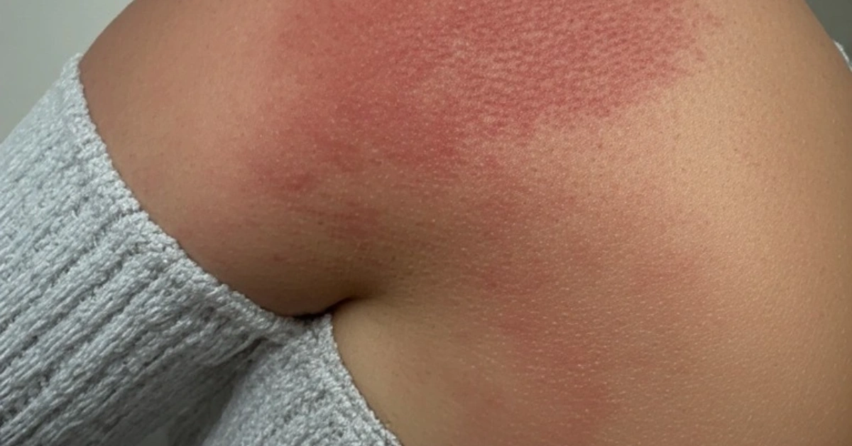 लुतो (Scabies): कारण, लक्षण र यसका प्रभावकारी घरेलु उपचारहरू