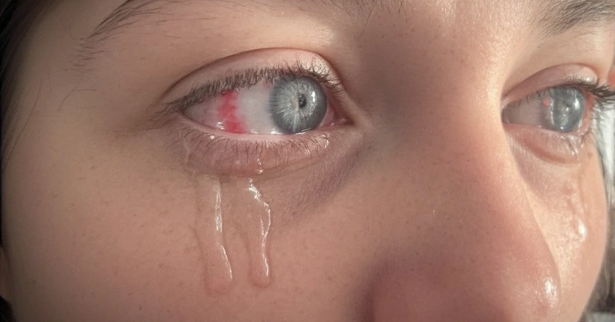 आँखा पाक्ने रोग (Eye Infection)