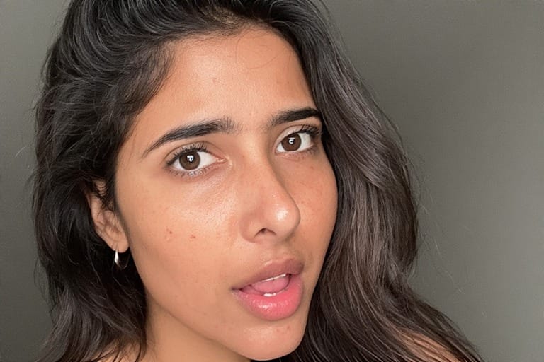 छालामा कालो दाग (Pigmentation)